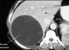 ficat Chist - simptome, tratarea și eliminarea