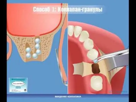 Нематода в максиларните симптомите на синусите и лечение, диагностика, особено