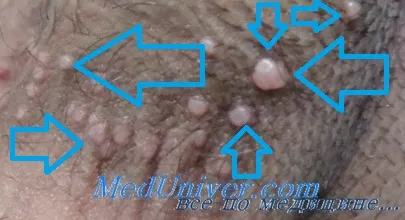 Molluscum контагиозум 1