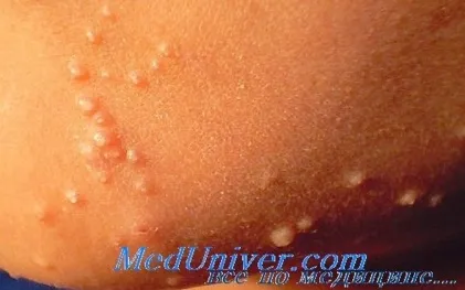 Molluscum contagiosum 1