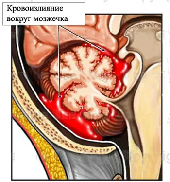 Кръвоизлив в малкия мозък, което е, причини и лечение, вашето здраве скалпа