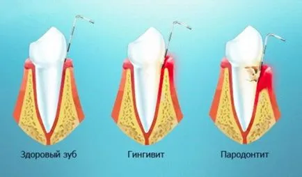 Fogínyvérzés - priiny és kezelések, a hagyományos orvoslás