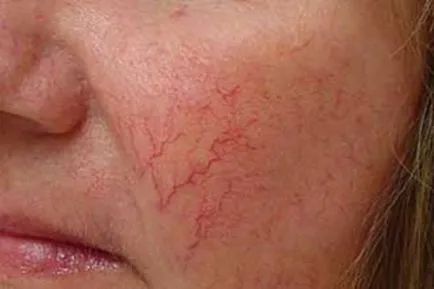 Rosacea arckezelés szalon kezelések és a hazai jogorvoslati