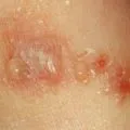 Tratamentul Eczema cu ASD - caracterizare, regim de recomandări