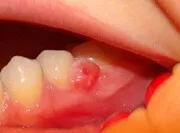 Лечение на стоматологични методи грануломи, характеристики цени и отзиви