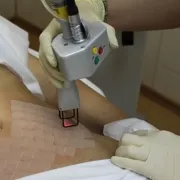 Tratamentul grid venoase (scleroterapia si mesh venos cu laser)