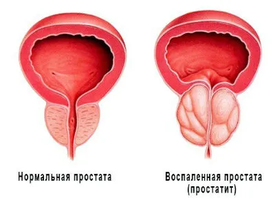 Лечение на хроничен простатит, признаците и симптомите на простатит