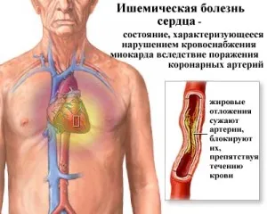 списък Сърдечно заболяване - лечение на сърцето