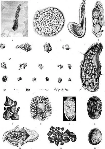 calculi biliari de colesterol