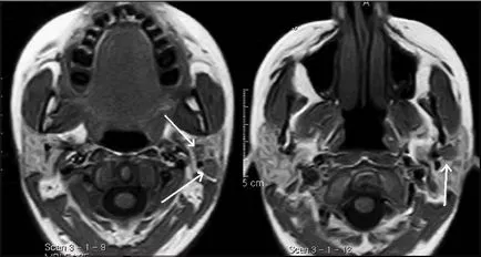 MRI на слюнчените жлези