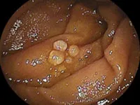 Limfomul non-Hodgkin - simpmtomy (simptome), tratament, prognostic, fotografie, cauze, diagnostic