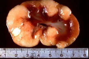 Limfomul non-Hodgkin - simpmtomy (simptome), tratament, prognostic, fotografie, cauze, diagnostic