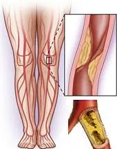 Оклузивна болест на долните крайници симптоми и лечение