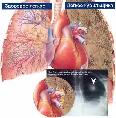 Tisztító a tüdőben a dohányos - tisztítás után dohányzás, eltávolítása tar, váladék, nyálka