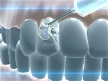 Денудация вратовете на зъбите - защо да се понижат като венците и лекува патологичен процес