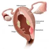 Mirigyes endometrium hiperplázia - szike - orvosi információk és oktatási portál