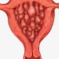 hiperplazie endometriala glandulară - bisturiu - informații medicale și portal educațional