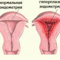 hiperplazie endometriala glandulară - bisturiu - informații medicale și portal educațional