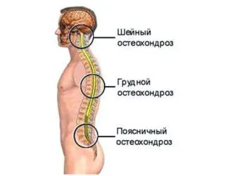 Osteochondrosis a mellkasi tünetek, kezelése és megelőzése