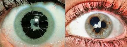 Maradék pupilla membrán - okok és a kezelés gyermekeknél