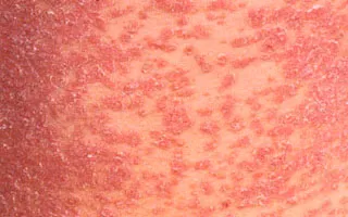 Diferentele psoriazis eczeme, dermatită și seboreea (ceea ce este diferența)