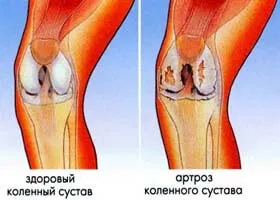 Periartrita articulației genunchiului - diagnostic si tratament