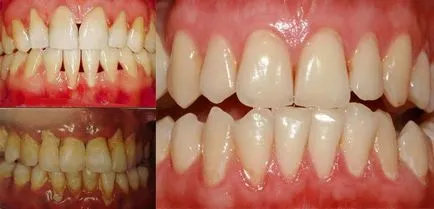 A periodontitis tünetei és kezelése, fotó formái parodontitis