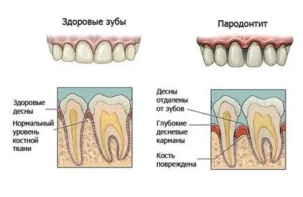 A periodontitis tünetei és kezelése, fotó formái parodontitis