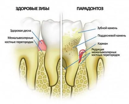 fotografii boala parodontala inainte si dupa tratament, spre deosebire de fotografie parodontită