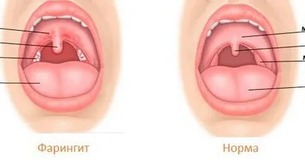 Tickle в гърлото и кашлица причина за, алергии, болки в гърлото, остър респираторен вирусната инфекция, симптоми, лечение, диагностика