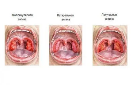 Tickle în gât și nas care curge ce să facă acasă cu remedii populare, antibiotice decât