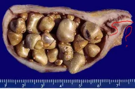 Хранене при заболявания на жлъчния мехур - помисли си всичко