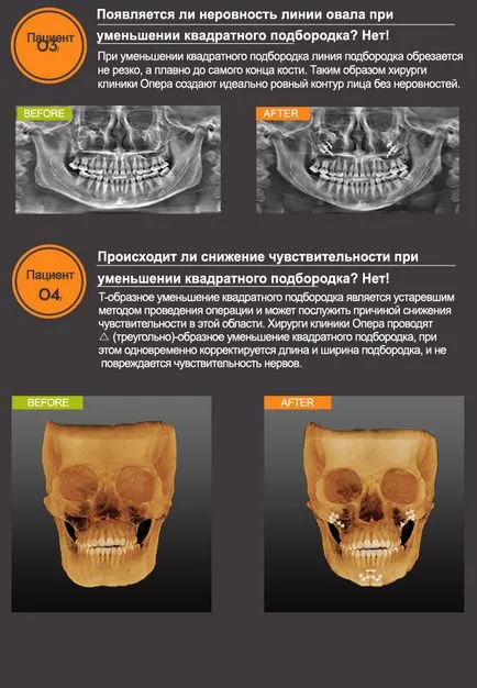 Пластмасови скули, брадичката и челюстта в Южна Корея