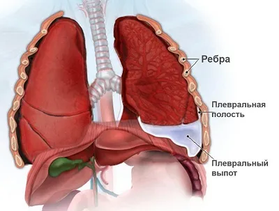 Pleurezia simptomelor copii și tratament