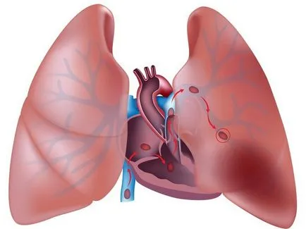 Pleurezia a plămânilor la copii cauze, simptome, diagnostic, tratament, diagnostic, tratament, consecințe,