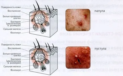 Pattanás, kimentem! 7 bőrápolási módszerek akne