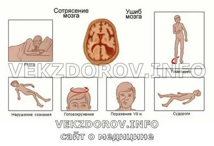 Principiile de tratament comotie la adulți