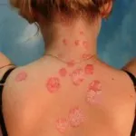 Psoriazis, dermatită atopică simptome, diagnostic și diferențele