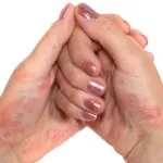 Psoriazis, dermatită atopică simptome, diagnostic și diferențele