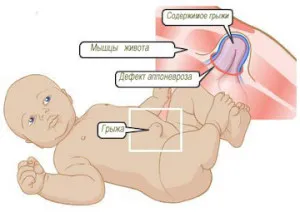 Пъпна херния при новородени, лекувани и експлоатация