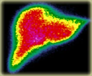 Examinarea Radionuclid a rinichilor, beneficiile și consecințele