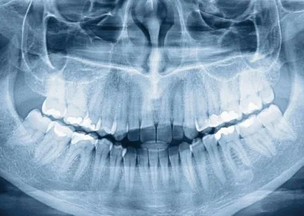 Radiografia - dinți în condiții de siguranță imagine - Masterdent