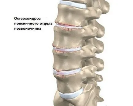 Gyakori (extenzív) osteochondrosis tünetek, kezelés