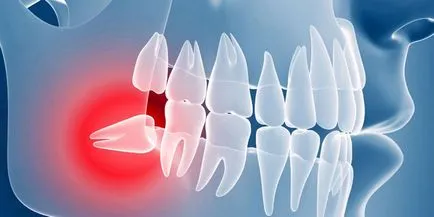 Повлияха зъб - причинява при деца и възрастни, третиране и обезвреждане