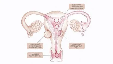 Зараждащата миома възел - Здраве академия на жените