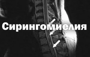 Syringomyelia nyaki és háti gerinc, gidromieliya, kezelés, népi jogorvoslat,