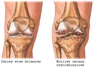 Forța de formare cu osteoartrita a articulației genunchiului a primului grad