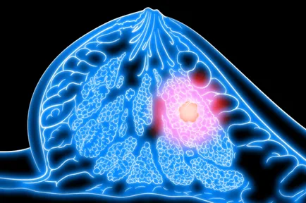 Симптоматика, причините и лечението на рака на гърдата фиброаденом
