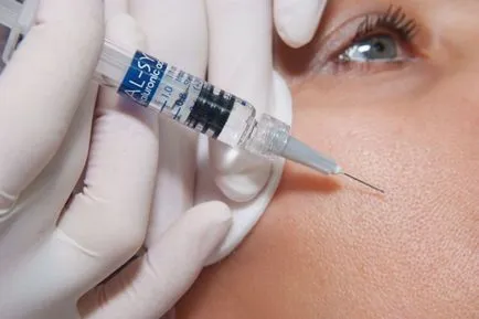 Vânătăi după injecțiile cu acid hialuronic