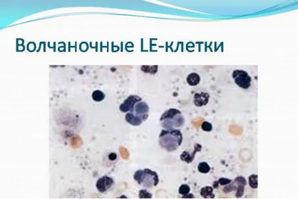 Системен лупус еритематозус - Симптоми, Причини, същността на заболяването, лечение на лупус и